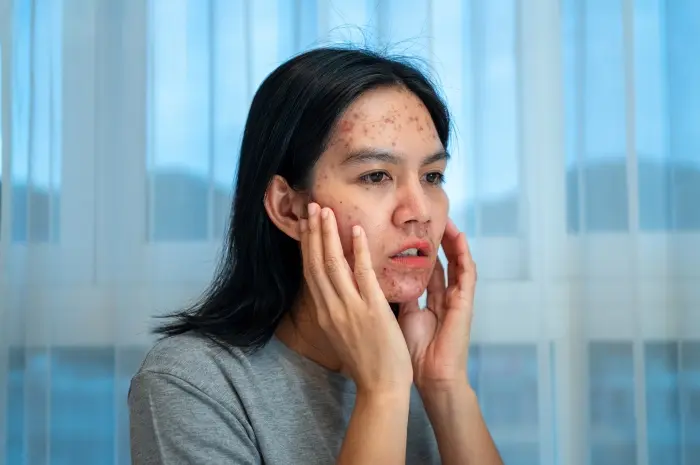 Kebiasaan Ini Diam-Diam Memperburuk Jerawatmu