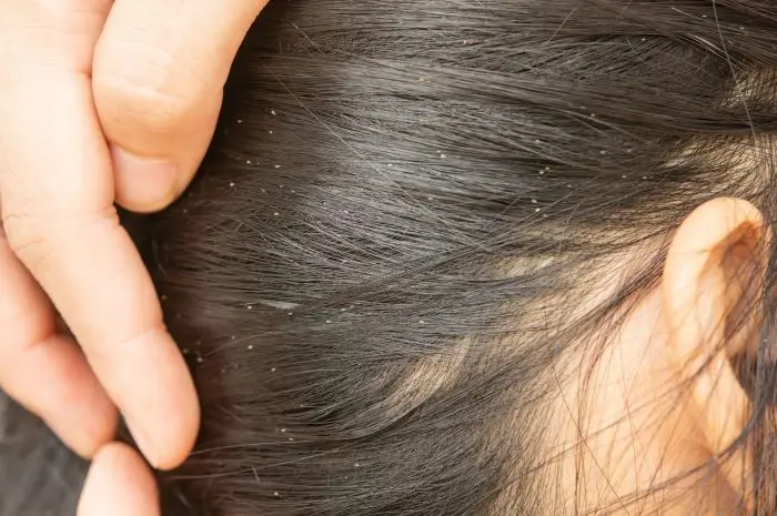 Causes of Head Lice