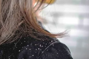 Perbedaan Ketombe Kering dan Ketombe Berminyak: Cara Mengenali dan Mengatasinya dengan Tepat