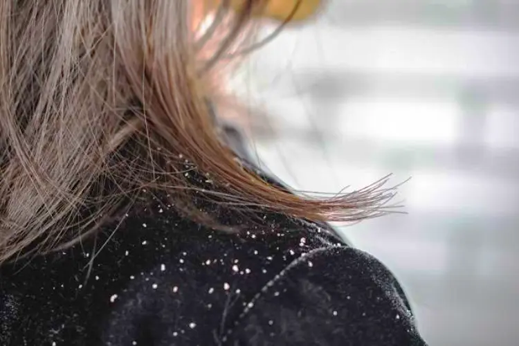 Perbedaan Ketombe Kering dan Ketombe Berminyak: Cara Mengenali dan Mengatasinya dengan Tepat